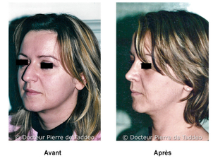 avant / après réduction des boules de Bichat