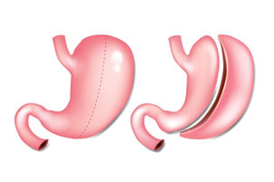 Sleeve gastrique