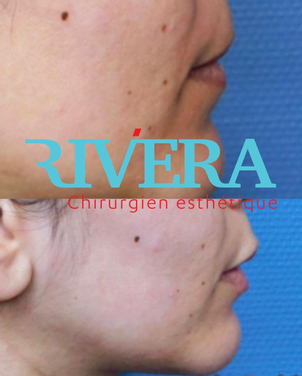 avant / après réduction des boules de Bichat