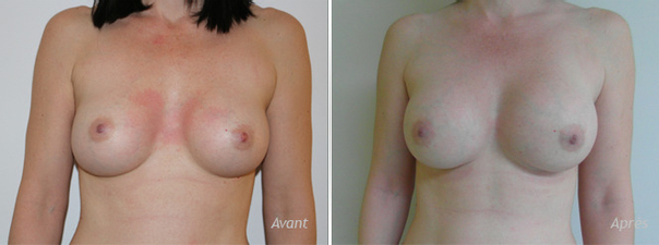Résultats du lipofilling mammaire