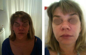 avant / après Chirurgie maxillo-faciale chez l’adulte