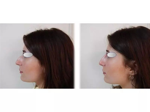 rhinoplastie médicale avant après
