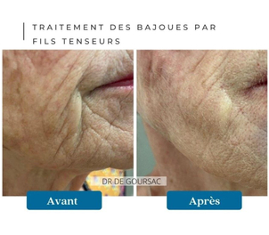 Traitement des bajoues par fils tenseurs par le Dr Catherine de Goursac
