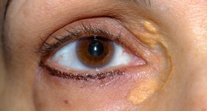 Xanthélasma