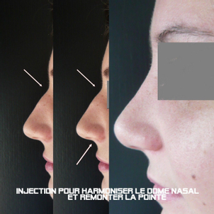 rhinoplastie médicale avant après