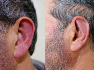 otoplastie avant / après