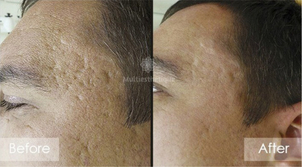 Microdermabrasion : pour qui ?
