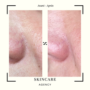 varices complications