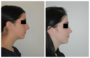 avant / après rhinoplastie