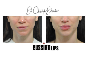 Photo du Docteur Christophe Desouches - Le Russian lips filler