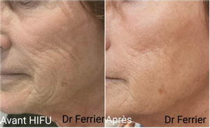 Avant - après HIFU par le Dr Lionel Ferrier