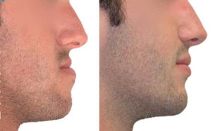 avant / après génioplastie