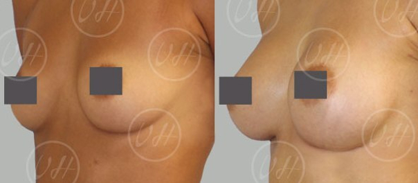 implants mammaires avant après