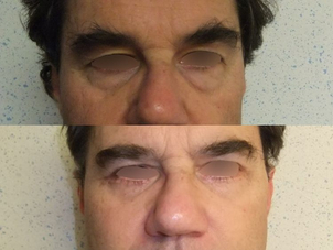 avant / après une blépharoplastie