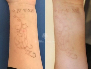 avant / après détatouage