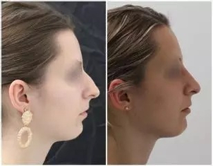rhinoplastie médicale avant après
