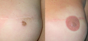 dermopigmentation avant apres