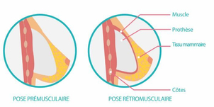 implantation de l'implant mammaire
