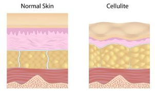 traitement anti-cellulite