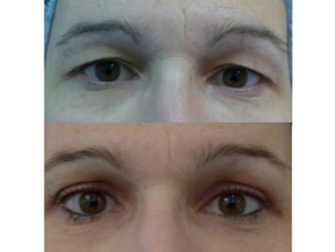 avant / après une blépharoplastie