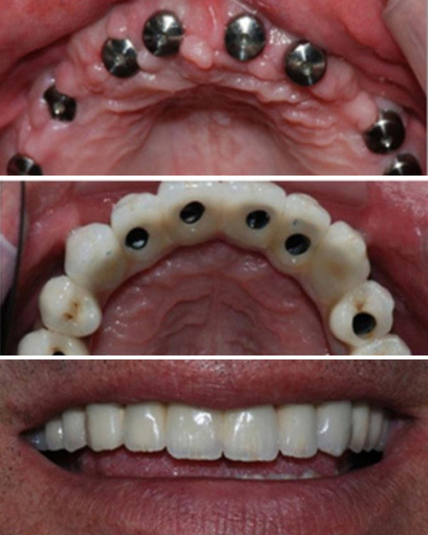 implants dentaires avant après 