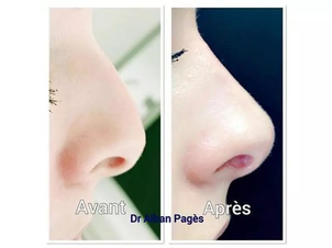 rhinoplastie médicale avant après
