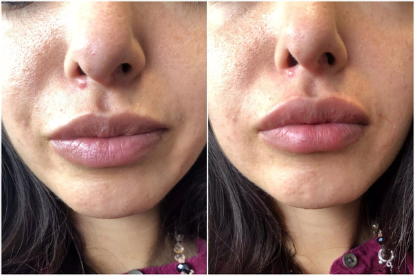 Avant / après augmentation des lèvres