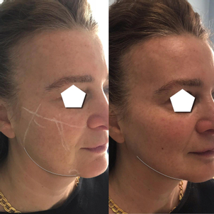 traitement anti rides avant après