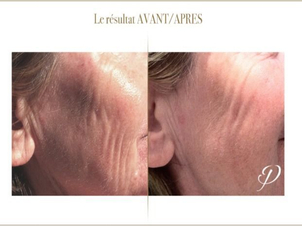 radiofrequence avant après