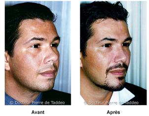 avant / après réduction des boules de Bichat