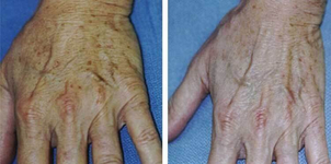 laser dermatologique avant apres