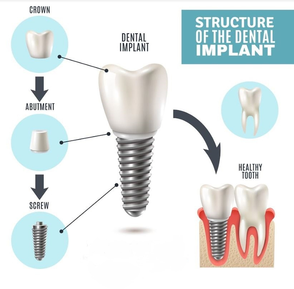 structure implant dentaire