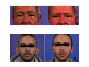 avant / après chirurgie maxillo-faciale