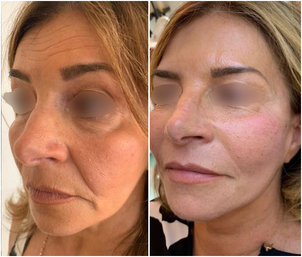 Avant après fils tenseurs