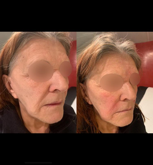 radiofrequence avant après