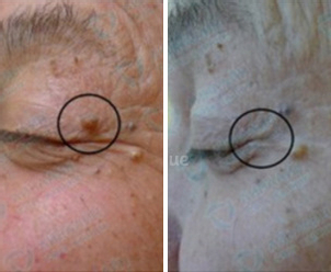 Avant / Après d'un traitement d'une verrue