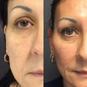 fils tenseurs avant / après