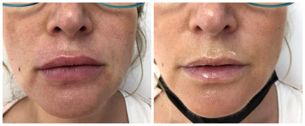 Augmentation des lèvres avant / après