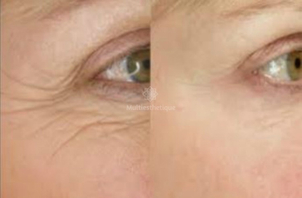 Photorajeunissement avant/après