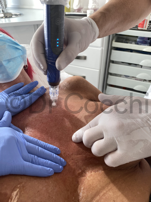 Séance de Microneedling avec le Dr Cocchi