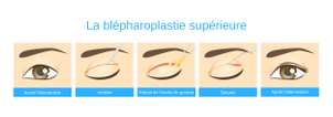 La blépharoplastie