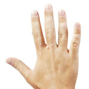 Verrues sur la main