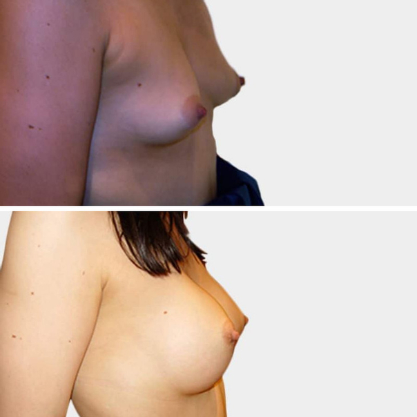 implants mammaires avant après