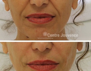 traitement anti rides avant après