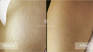 Vergetures avant/après