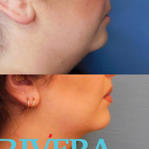 avant / après réduction des boules de Bichat