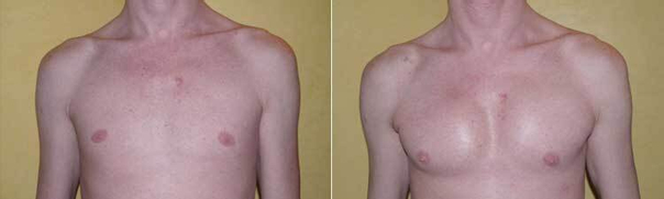 avant / après implants pectoraux