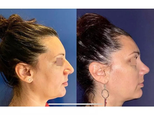 avant / après rhinoplastie