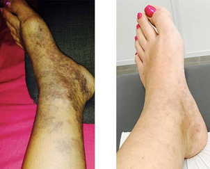 varices avant après