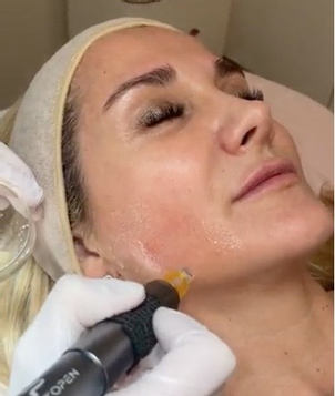 microneedling
